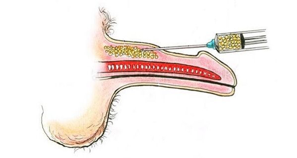 Ενέσεις υαλουρονικού οξέος κατά τη διάρκεια ενός μέλους για να το αυξήσει